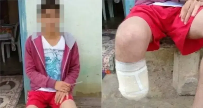  Homem amputa o próprio pé para tentar receber R$ 1,5 milhão em seguros 